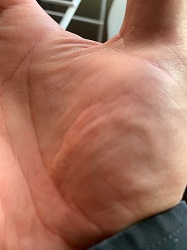 Geoffrey Collins' scar on his hand